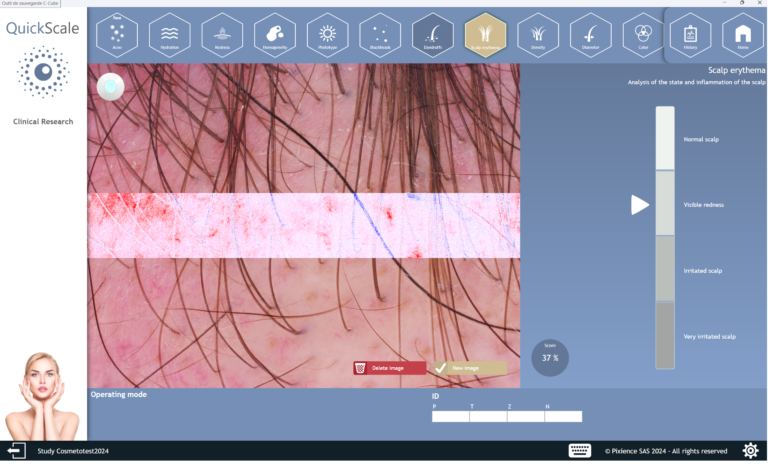 Index d'érythème du cuir chevelu